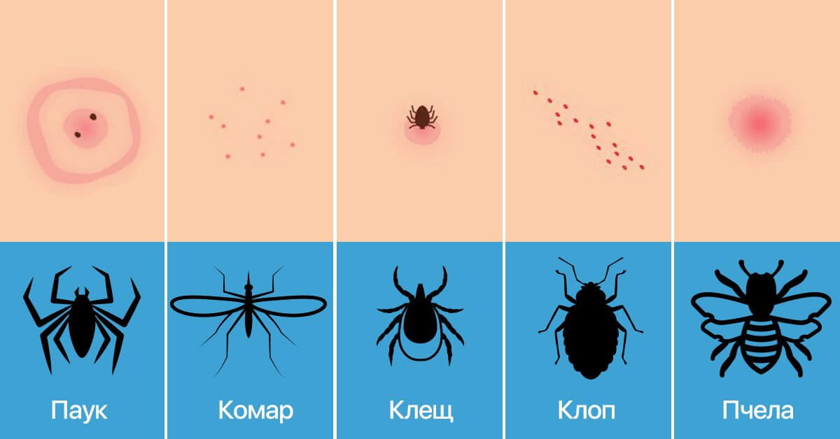 Как выглядят укусы разных насекомых